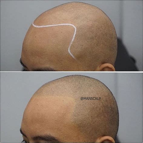 Scalp Micropigmentation in Manila, Philippines • Check Prices.